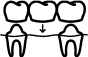 Dental Bridge